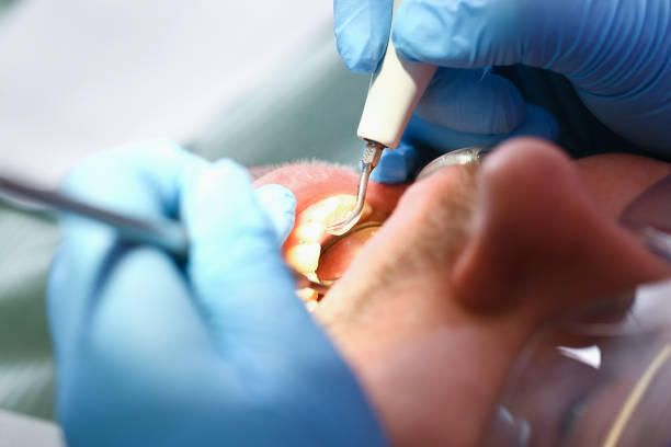 Best Emergency Tooth Extraction in Forsyth, MT